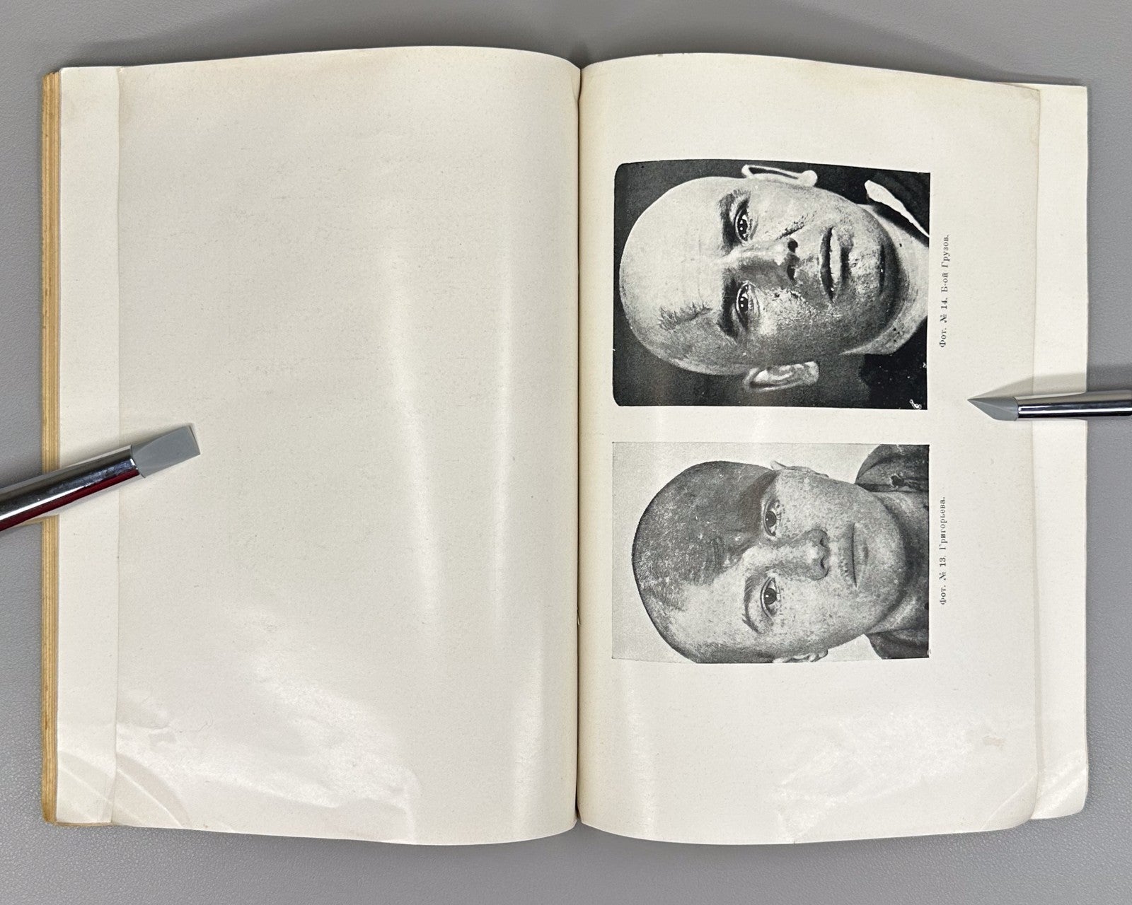 Recklinghausen Disease Medicine 1930 Злотников Болезнь Реклингаузена