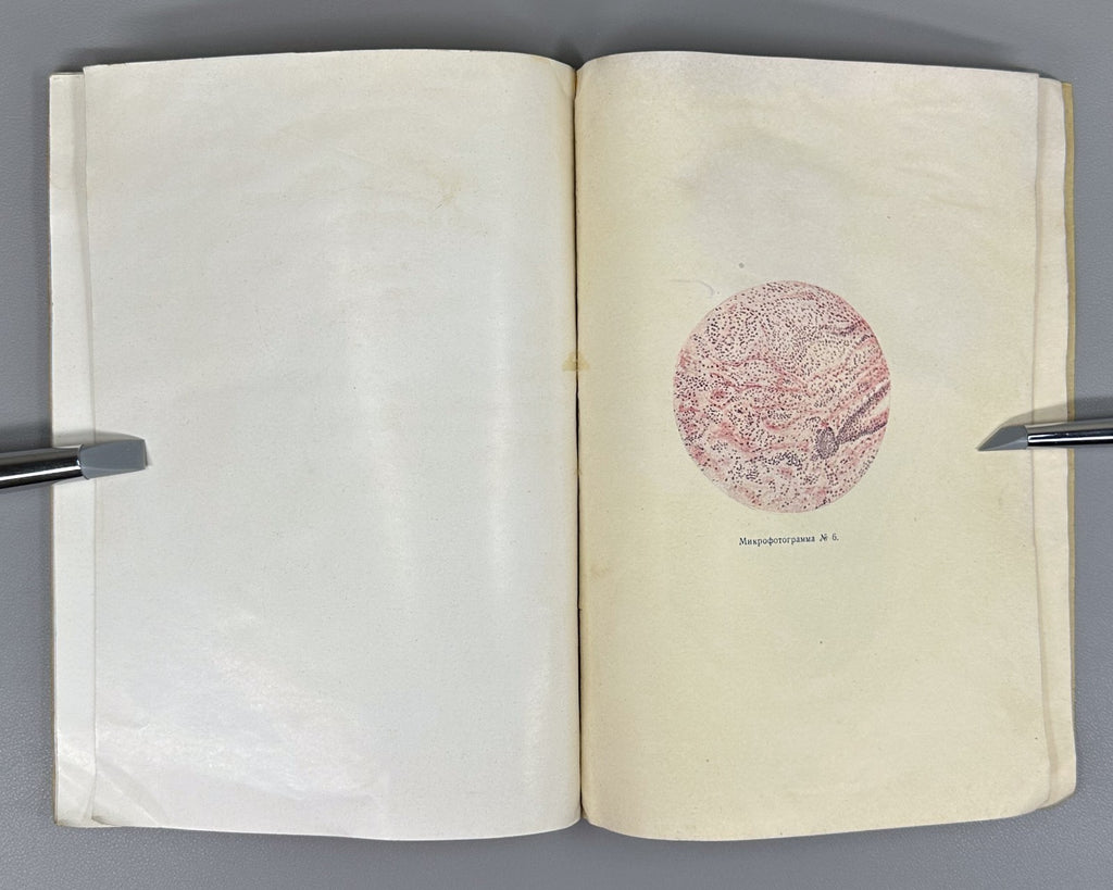 Recklinghausen Disease Medicine 1930 Злотников Болезнь Реклингаузена