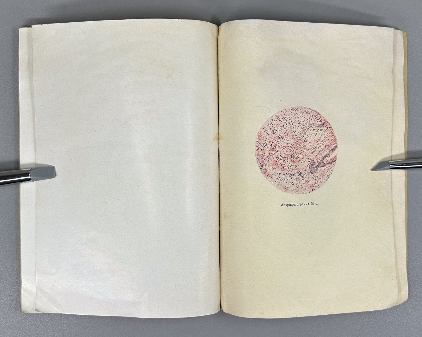 Recklinghausen Disease Medicine 1930 Злотников Болезнь Реклингаузена