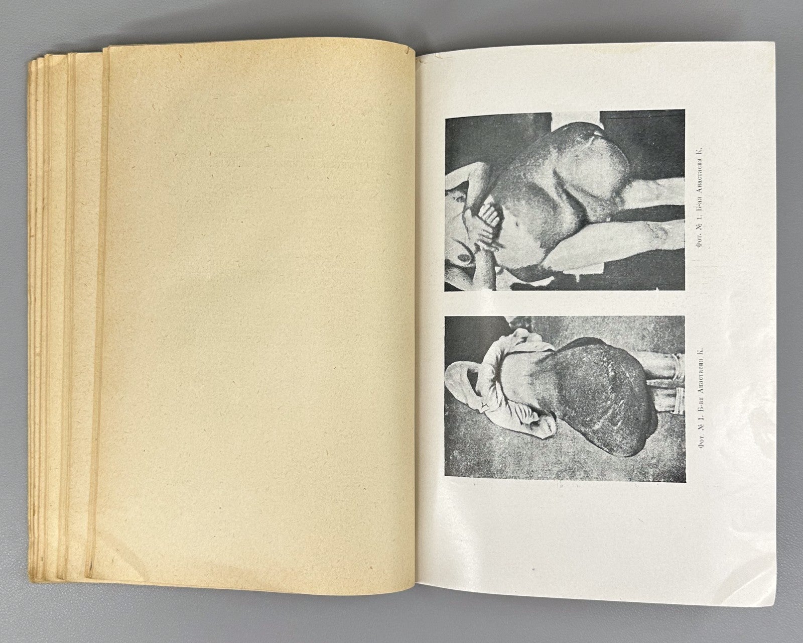 Recklinghausen Disease Medicine 1930 Злотников Болезнь Реклингаузена