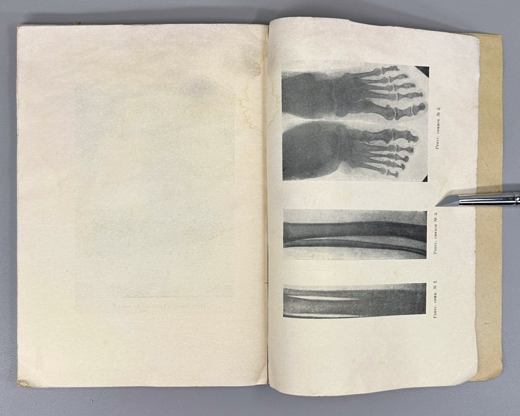 Recklinghausen Disease Medicine 1930 Злотников Болезнь Реклингаузена